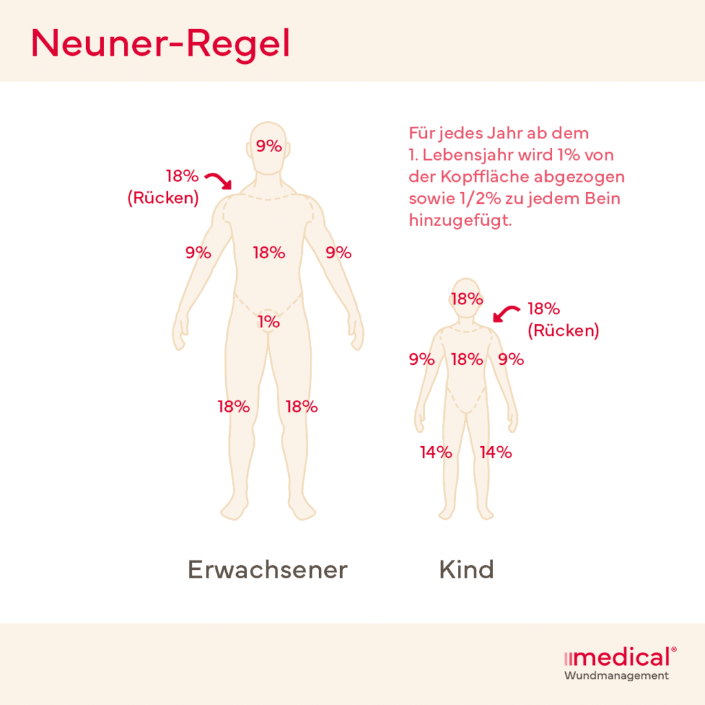 Verbrennungen Neuner-Regel Grafik